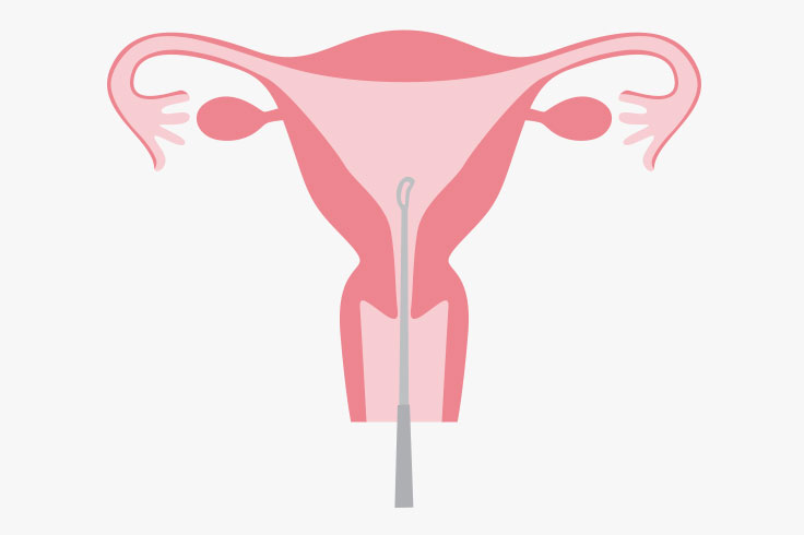 子宮内膜着床能（ERA）検査イメージ